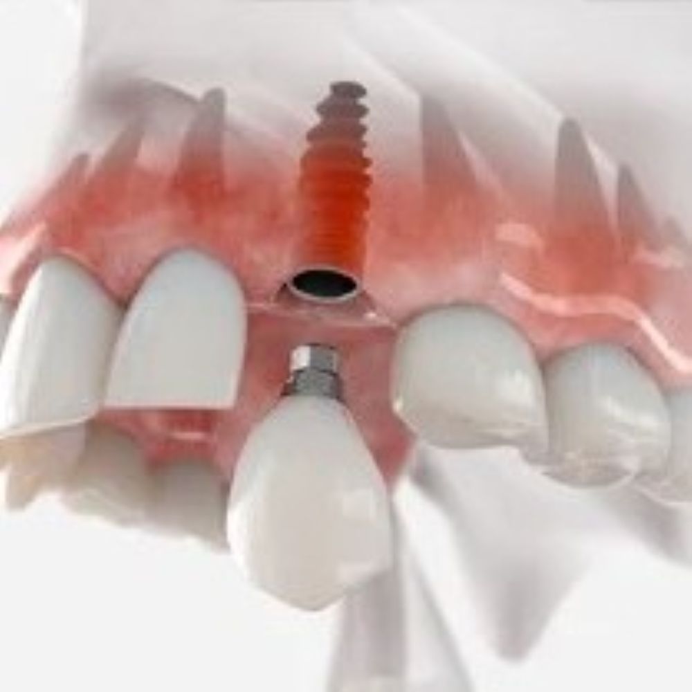 Edentulous