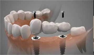 Edentulous