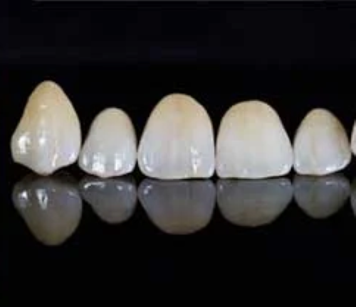4 - 6 Implants